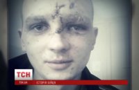 Причуды могилизации. Ослепшего после ранения на один глаз укровоина снова отправили на фронт