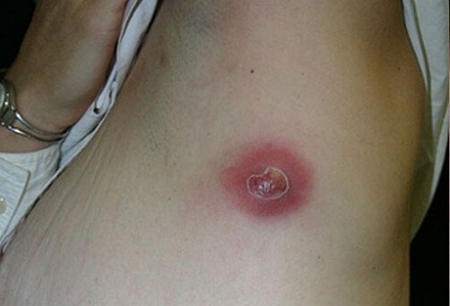 Фурункул имени Путина