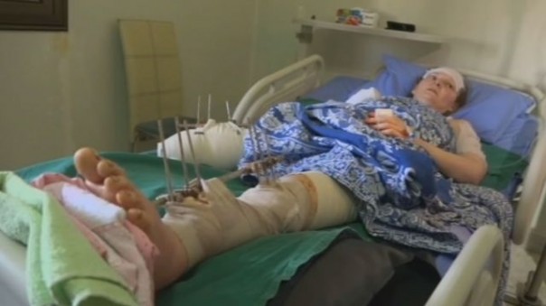 Россиянка в Сирии потеряла кисть руки и ногу, спасая детей от мины