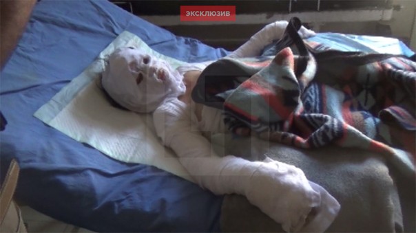 Западные СМИ выдали пострадавшую от пожара девочку за жертву удара ВКС РФ