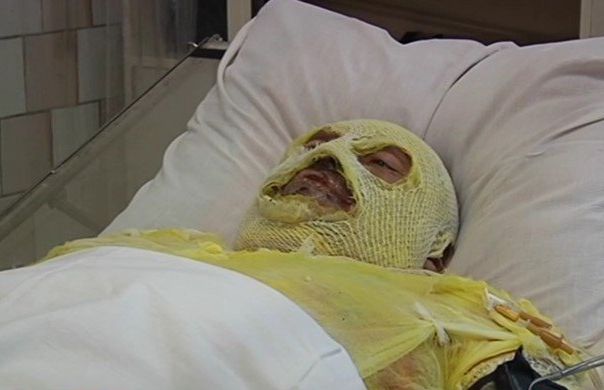 Хрюмберг которому "МАЛО": Получивший под Дебальцево ожоги 80% тела пообещал вернуться в зону "АТО"