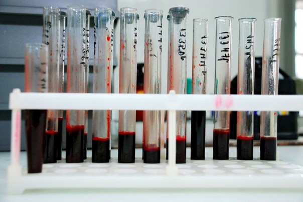 Мигранты завезли в Россию новый штамм ВИЧ