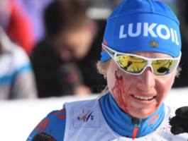 Российская лыжница продолжила гонку, несмотря на рассеченую щёку и кровь (Видео)