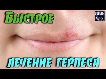 Как быстро избавиться от герпеса на губах в домашних условиях. Полезные советы