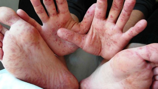 Украинцы принесли корь в Польшу