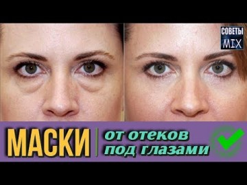 Как убрать отеки и мешки под глазами в домашних условиях из простых продуктов. Народные рецепты