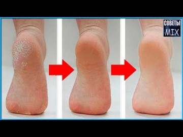 Сода для пяток. Как почистить пятки с помощью пищевой соды в домашних условиях. Рецепт здоровья