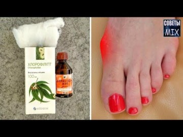 Узнайте что нужно сделать, чтобы косточка на ноге не болела. Простой рецепт всего из 2-х ингредиентов. Рецепт здоровья
