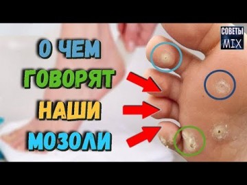 Узнайте что означают ваши любимые мозоли на ногах. Интересные факты о здоровье, которые вы могли не знать