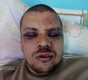 Жителю Кременчуга за георгиевскую ленту сломали нос и выбили 10 зубов