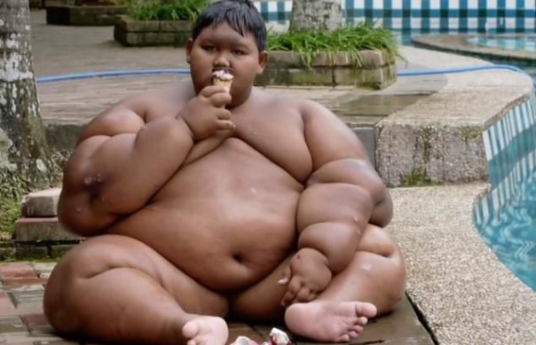 Глобальное ожирение