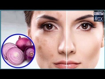 Простое средство, которое отбеливает пигментные пятна очень быстро. Как избавиться от пигментных пятен