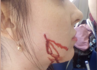 Проткнула щёку. В Воронеже сотрудница банка вонзила ручку в лицо клиентки
