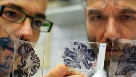 Болезнь Альцгеймера может развиться из-за инфекции в полости рта