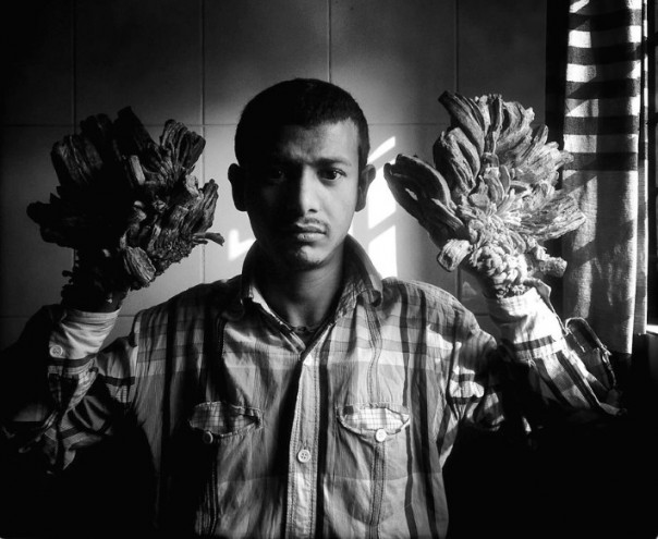 Превращение в «дерево»: редчайшее заболевание в мире