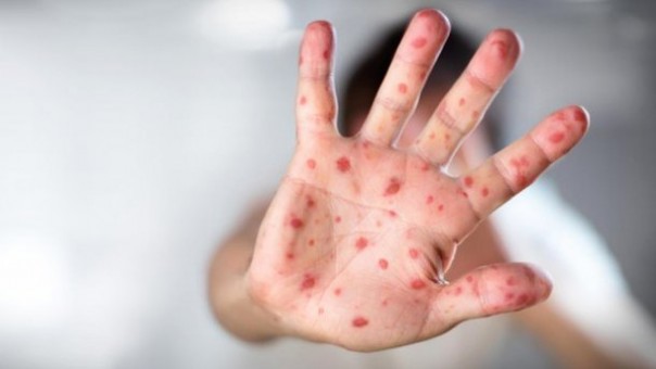 На Украине за неделю корью заболели 485 человек