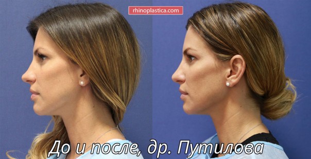 А знаете ли вы, что можно изменить форму носа без операции?