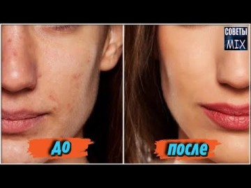 Как избавиться от акне: Правильное питание от прыщей на лице. Самые полезные советы для здоровья