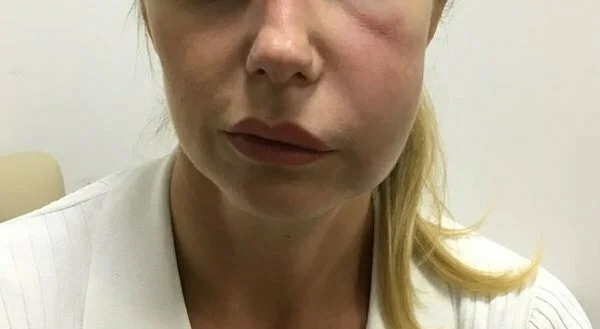 Отек после имплантации зубов