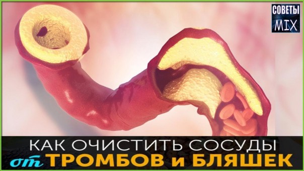 Как защитить сосуды от тромбов и старения. Очищение сосудов от холестериновых бляшек. Секрет здоровья