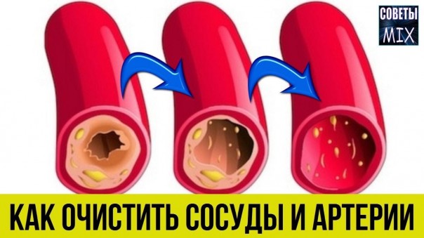 Как просто и легко очистить сосуды и артерии от холестериновых бляшек без таблеток. Секрет здоровья