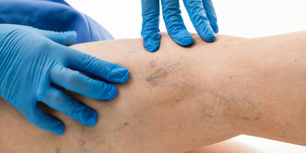 Запись на консультацию к флебологу