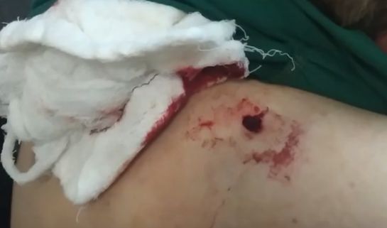 Медики будут оперировать раненую огнем ВСУ женщину