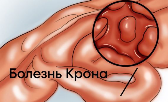 Что такое болезнь Крона?