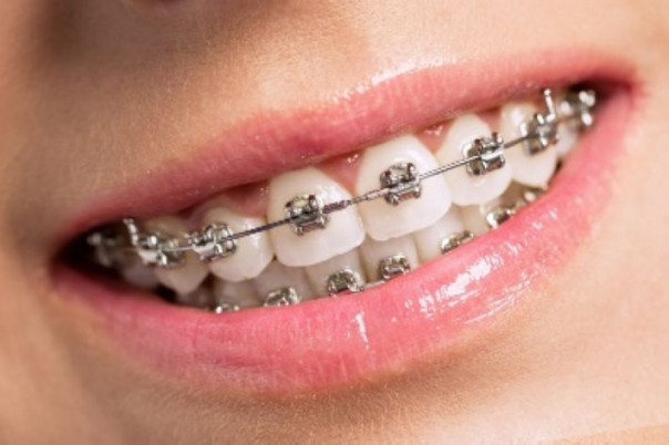 Правильный уход за брекет-системой: памятка для пациентов