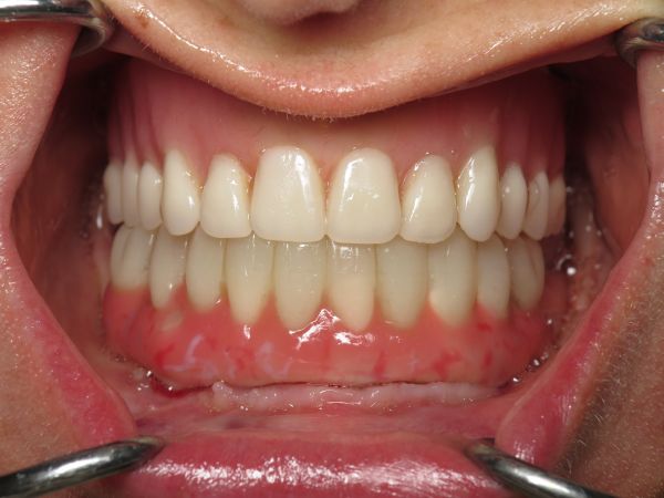 Возможности и варианты протезирования на имплантах