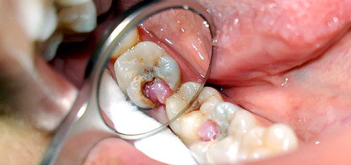 Как бороться с пульпитом