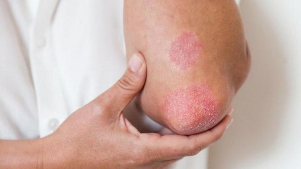 Аллергия на пластырь: способы лечения и профилактики