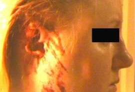 Драма в Подмосковье: ревнивец оторвал ухо своей сожительнице