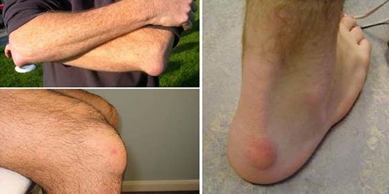 Бурсит – беда для суставов: что это за проблема и как её избежать