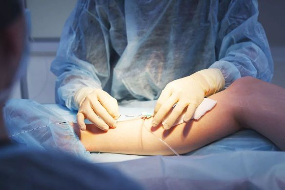 Варикоз: почему нужно обратиться к врачу