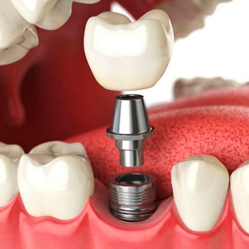 Какие импланты зубов выбрать