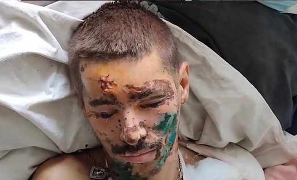 Военнопленный ВСУ рассказал, что рад прохождению лечения в больнице ДНР