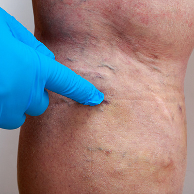 Прием флеболога: чем занимается врач и какое лечение назначает