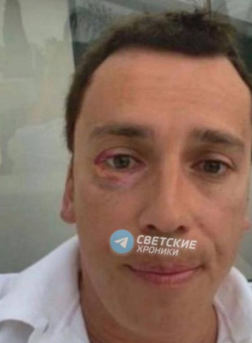 Максиму Галкину прилетело яблоко в глаз на одном из концертов в Израиле за юмор о России