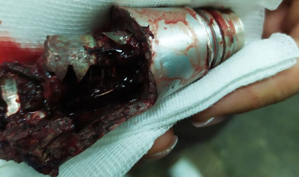 «Страха не было»: врачи удалили осколок взрывателя из ноги военнослужащего