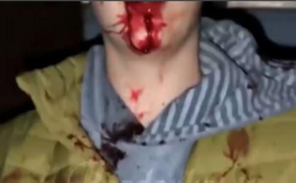 В Смоленской области подросток избил сына добровольца спецоперации — мальчик лежит в реанимации и может остаться инвалидом на всю жизнь