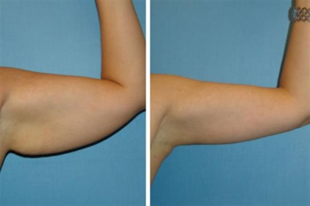 Показания и подготовка к операции по подтяжке кожи рук