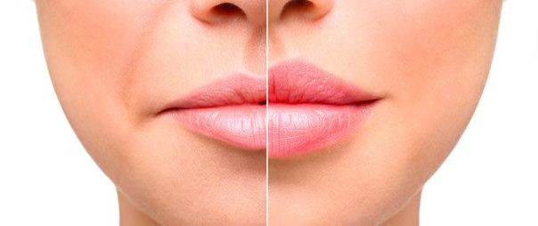 Все, что нужно знать про контурную пластику губ