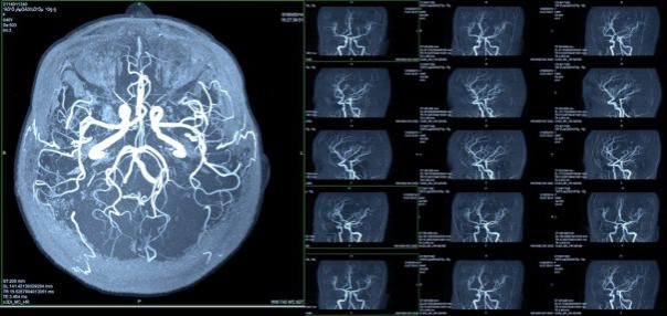 Как проходит МРТ ангиография и как к ней подготовиться